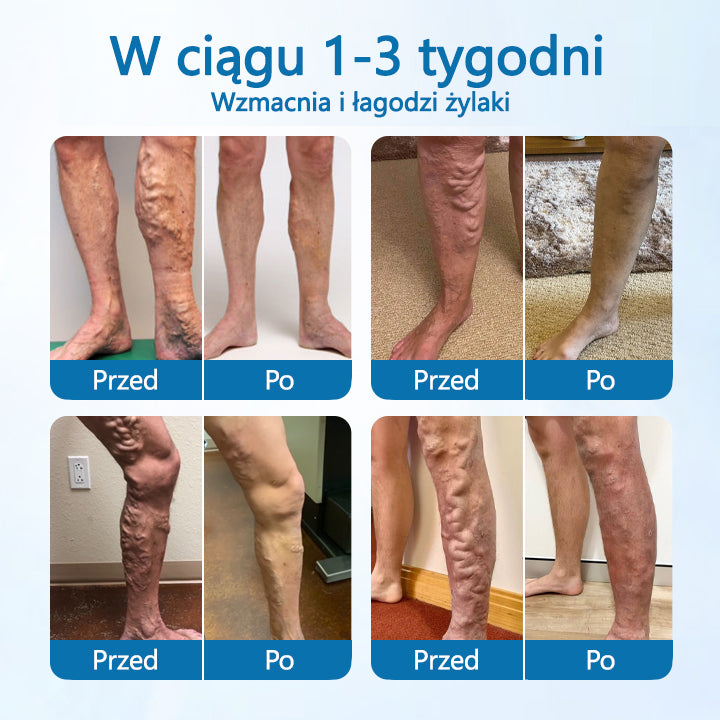 🌿🌿 Timilk® VeinGuard – Ziołowy Spray na Żylaki z Potwierdzoną Skutecznością w 7 Dni!