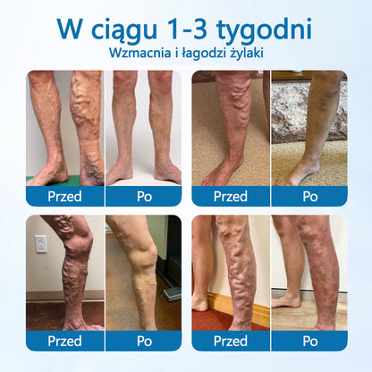 🌿🌿 Timilk® VeinGuard – Ziołowy Spray na Żylaki z Potwierdzoną Skutecznością w 7 Dni!