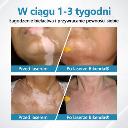 Bikenda® DermaBeam Urządzenie Terapeutyczne do Leczenia Bielactwa