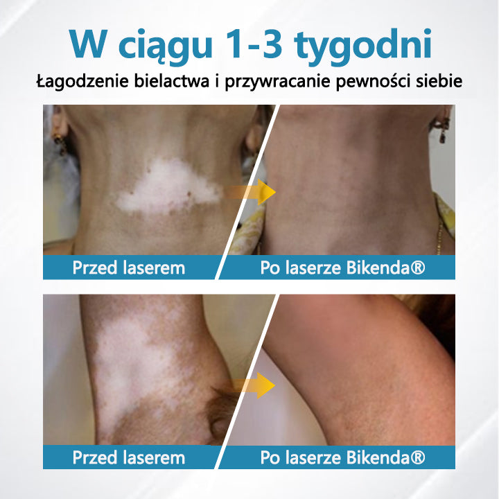 Bikenda® DermaBeam Urządzenie Terapeutyczne do Leczenia Bielactwa