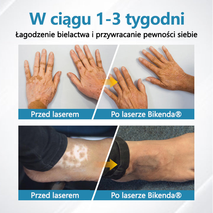 Bikenda® DermaBeam Urządzenie Terapeutyczne do Leczenia Bielactwa