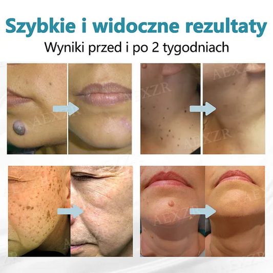Bikenda® ❤️Laser Pen do nieinwazyjnego usuwania znamion i brodawek